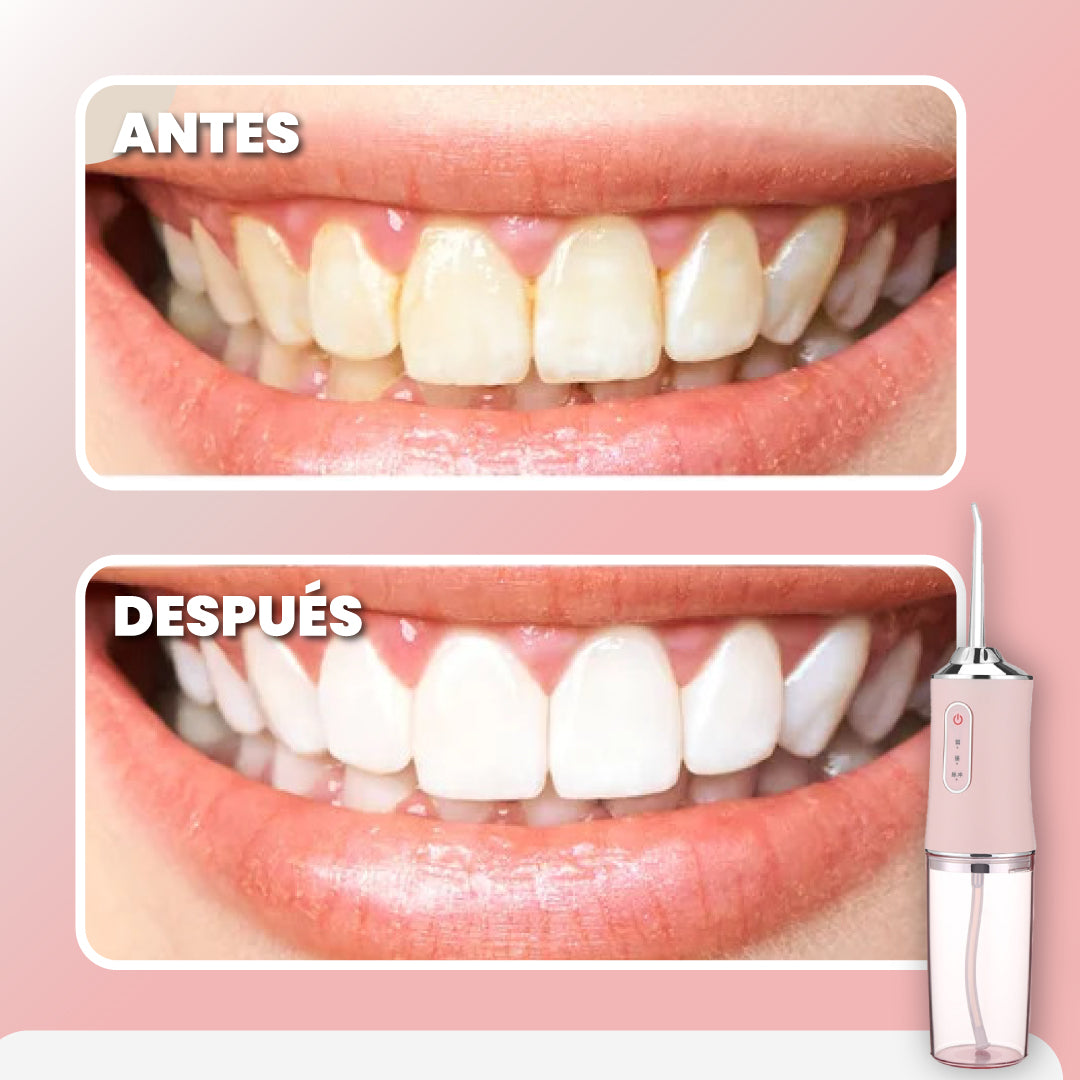 Limpiador de sarro y suciedad dental - Oral Irrigator™