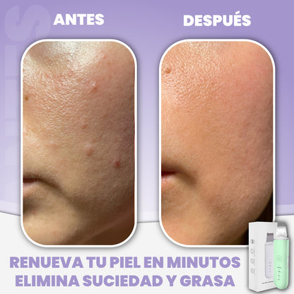 Limpiador facial ultrasónico de impurezas - Sonic Glow™