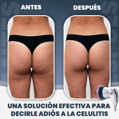 Masajeador anticelulitis 4 en 1 - Massager Pro™