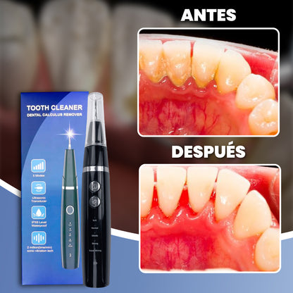 Limpiador ultrasónico de sarro - ProDent™