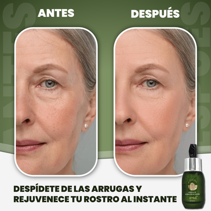 Botox facial para arrugas - Bot Solution™